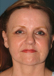After Image: Patient # 64128 - front