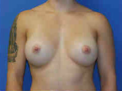 After Image: Patient # 87448 - front