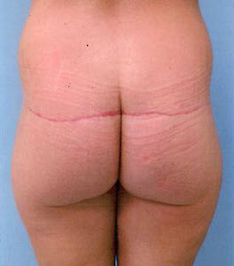 After Image: Patient # 22881 - front