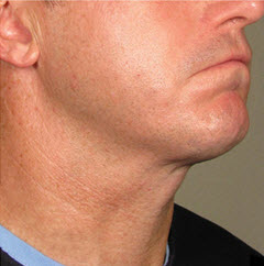 After Image: Patient # 21638 - 