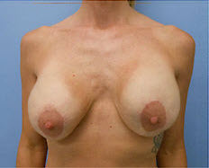 Before Image: Patient # 27241 - front