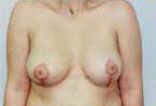 After Image: Patient # 62107 - front