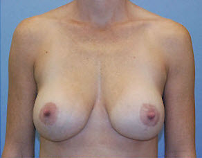 After Image: Patient # 98814 - front