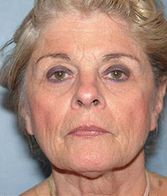 Before Image: Patient # 53232 - front