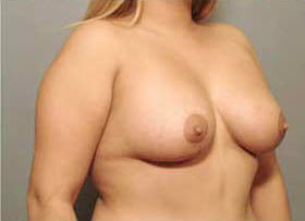 After Image: Patient # 45931 - front