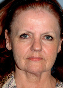 Before Image: Patient # 64128 - front