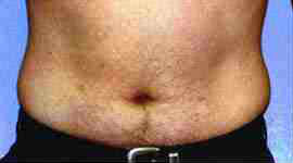 Before Image: Patient # 56482 - front