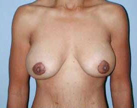 After Image: Patient # 75580 - front