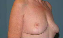 After Image: Patient # 82697 - front