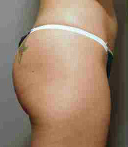 Before Image: Patient # 89687 - front