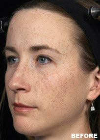 Before Image: Patient # 30317 - front