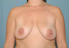 Before Image: Patient # 24878 - front