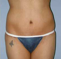 After Image: Patient # 99846 - front