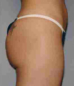 After Image: Patient # 89687 - front