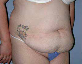 Before Image: Patient # 30777 - front