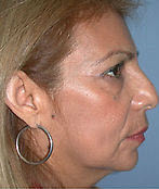 Before Image: Patient # 15839 - front