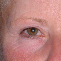 Before Image: Patient # 82613 - 