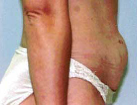 Before Image: Patient # 42393 - front
