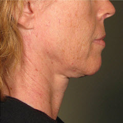 Before Image: Patient # 97368 - 
