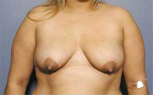 Before Image: Patient # 45931 - front