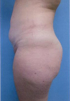 Before Image: Patient # 88045 - front