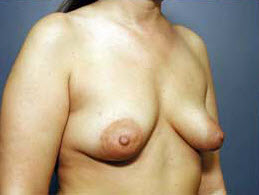 Before Image: Patient # 34333 - front