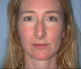 Before Image: Patient # 13120 - front