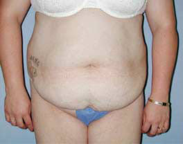 Before Image: Patient # 30777 - front