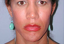Before Image: Patient # 97273 - front