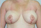 After Image: Patient # 62107 - front