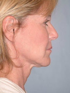 Before Image: Patient # 45203 - front
