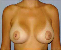 After Image: Patient # 37240 - front