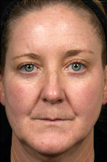 After Image: Patient # 39111 - front
