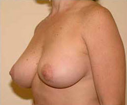 After Image: Patient # 54253 - front