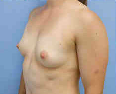 Before Image: Patient # 87448 - front