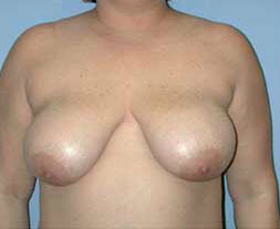 Before Image: Patient # 47627 - front