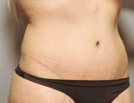 After Image: Patient # 65074 - front