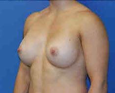 After Image: Patient # 87448 - front