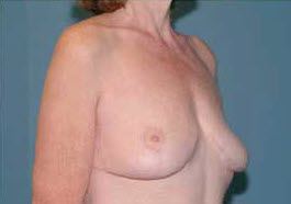 After Image: Patient # 71625 - front