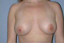 After Image: Patient # 28080 - front