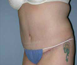 After Image: Patient # 30777 - front