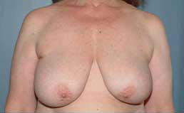 Before Image: Patient # 82697 - front