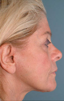 After Image: Patient # 53232 - front