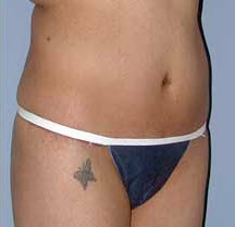 After Image: Patient # 99846 - front