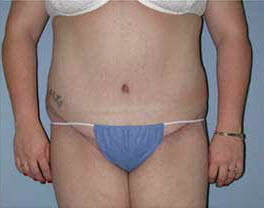 After Image: Patient # 30777 - front