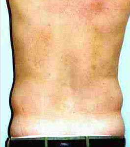 Before Image: Patient # 55828 - front