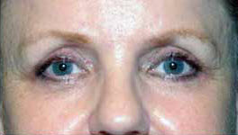 After Image: Patient # 77178 - 