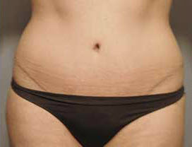 After Image: Patient # 65074 - front