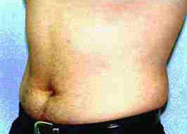 Before Image: Patient # 56482 - front