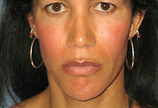 After Image: Patient # 97273 - front